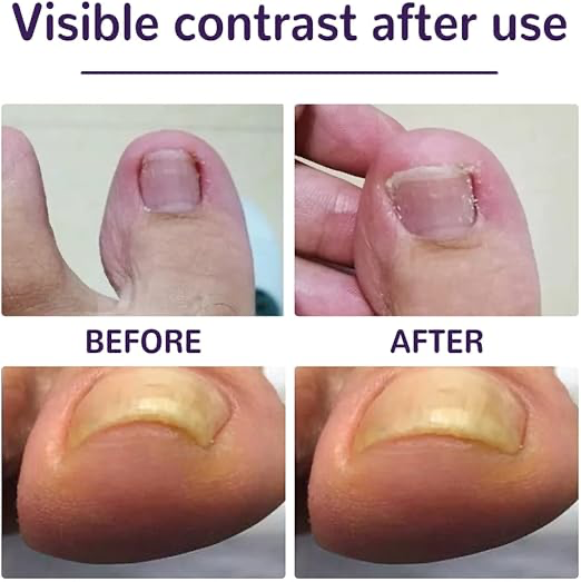 Ayak Tırnağı Düzeltme Bandı 50 Adet - 2